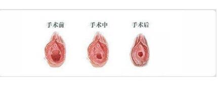 昆明处女膜修复需要多长时间